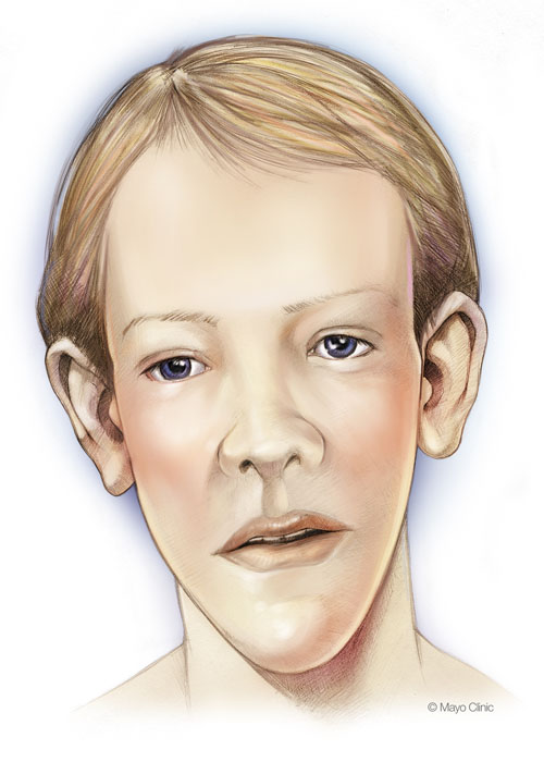 Soto_Syndrome (3).jpg
